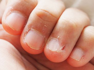 The Power of Hypnotherapy in Letting of Nail Biting