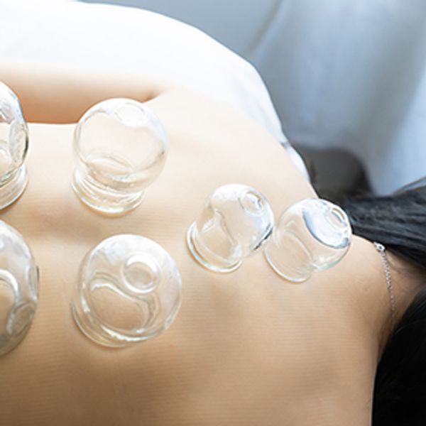 Acupuncture and cupping in Coquitlam now available at Ocean Bay Wellness