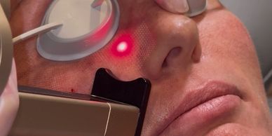 close up of face with goggles covering eyes and red laser being pressed on face 