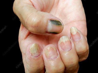 How to Treat Green Nails at Home