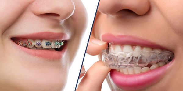 metal braces and clear aligner