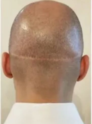 back of male head with long linear scar from old FUT hair transplant proceedure 