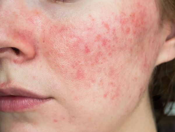 Close-up of a face with red, inflamed acne on the cheek.