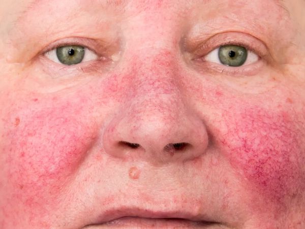 Close-up of a face with red, inflamed skin and visible veins.