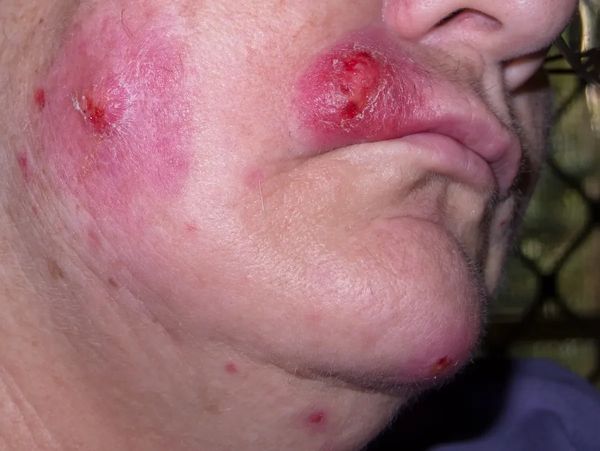Close-up of inflamed, red acne lesions on a person's cheek and chin.
