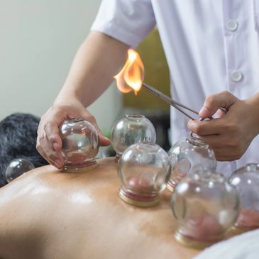 A patient is in Fire Cupping session at Li Zhang Holistic Acupuncture clinic, 19 W45th St, Suite 501