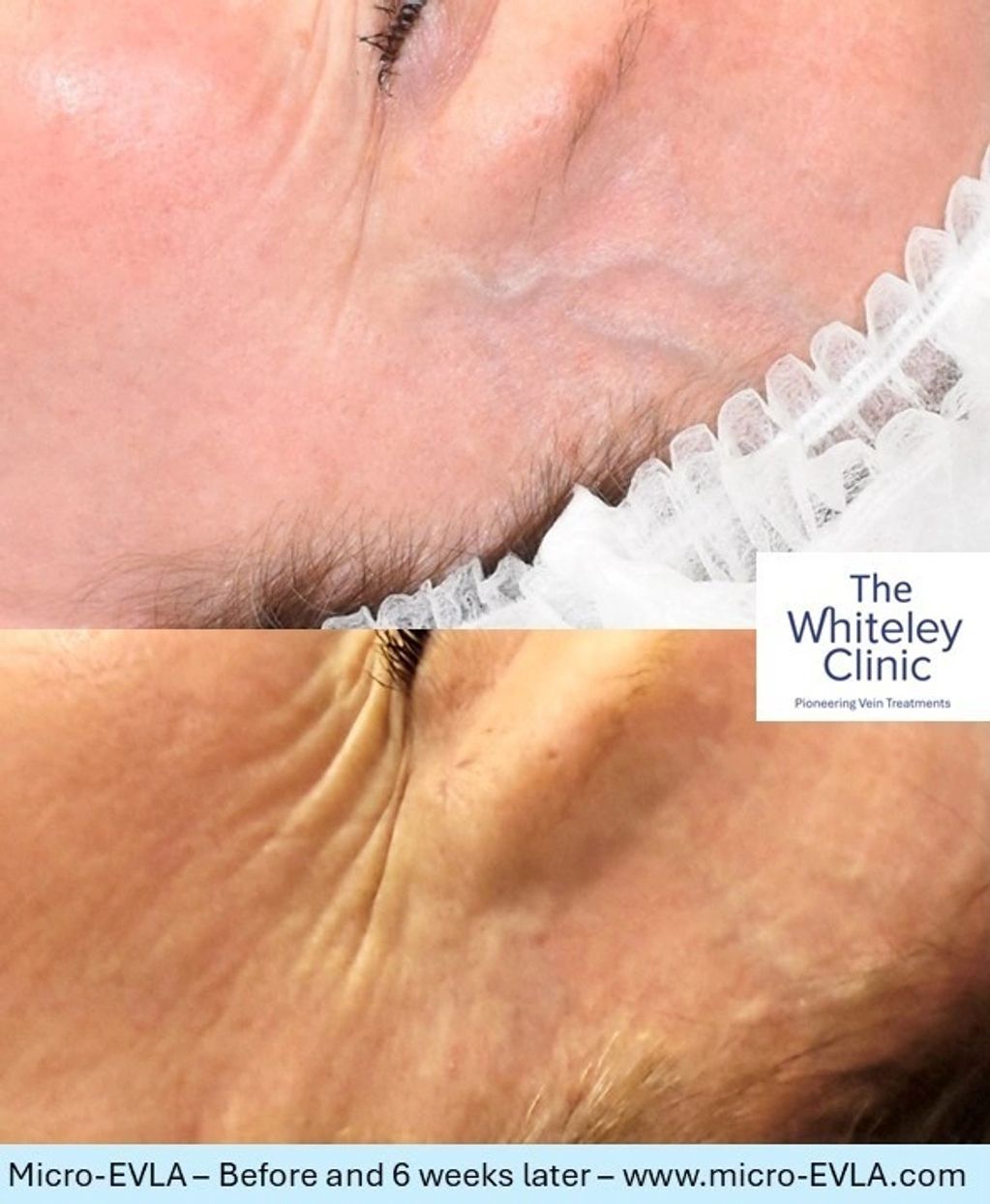 Before and after images of bulging leftt temple veins treated with Micro-EVLA by Mark Whiteley