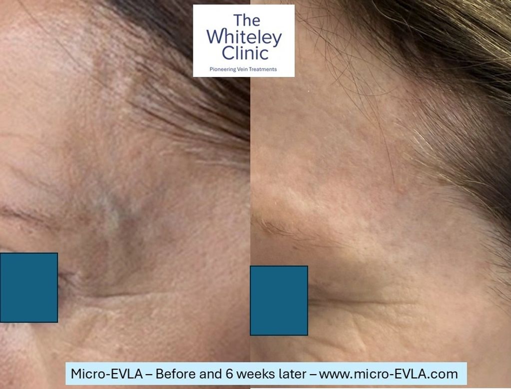 Before and after images of bulging left temple veins treated with Micro-EVLA by Mark Whiteley
