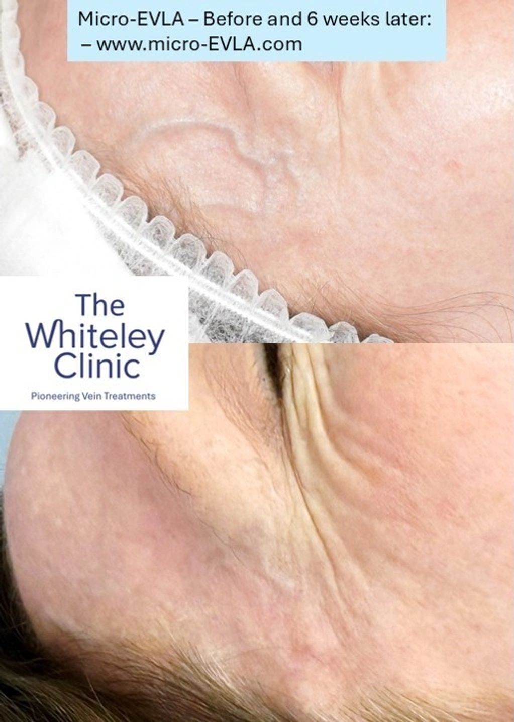 Before and after images of bulging right temple veins treated with Micro-EVLA by Mark Whiteley