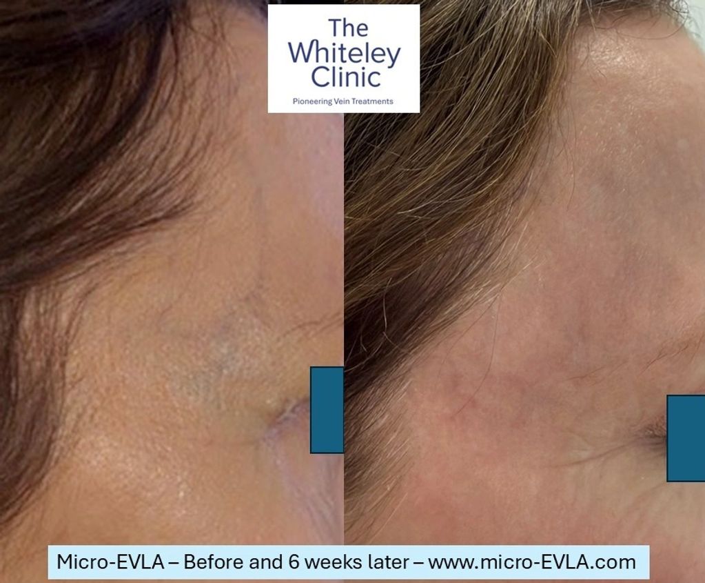 Before and after images of bulging right temple veins treated with Micro-EVLA by Mark Whiteley.