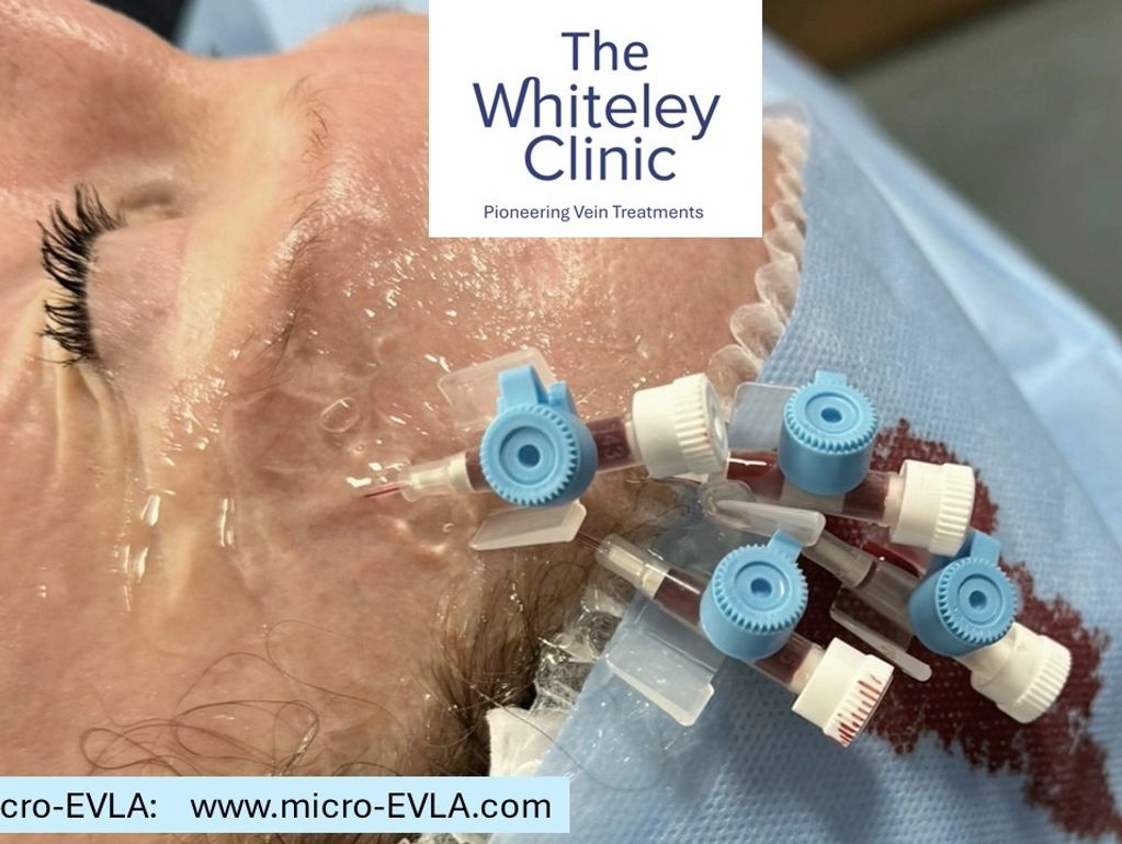 Micro-EVLA of left temple veins - veins are cannulated and ready for treatment.