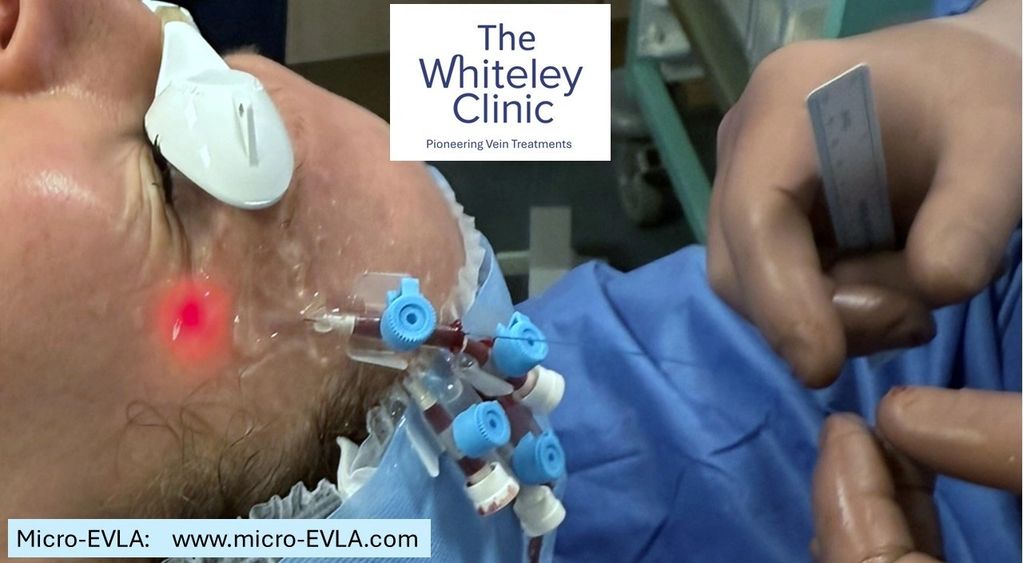 Micro-EVLA of left temple veins - veins are being treated with a 272 micron laser fibre.
