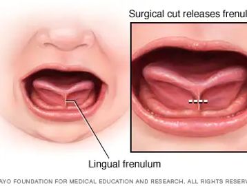 Lingual Frenectomy, ankyloglossia, Tongue tie, Tongue-tie, Evalina Josefsson
5400 Balboa Blvd, #308 