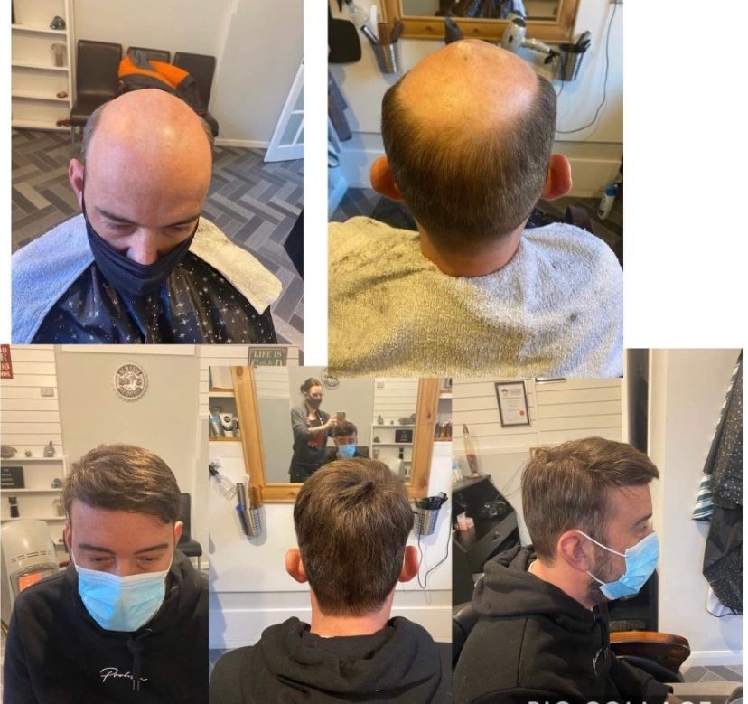 Hair loss Darlington - non surgical hair replacement system UK