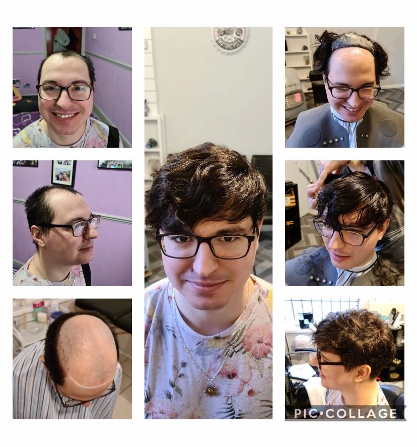 Hair loss to hair replacement system for men 