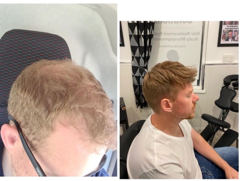 Men’s hair loss - hair replacement UK
