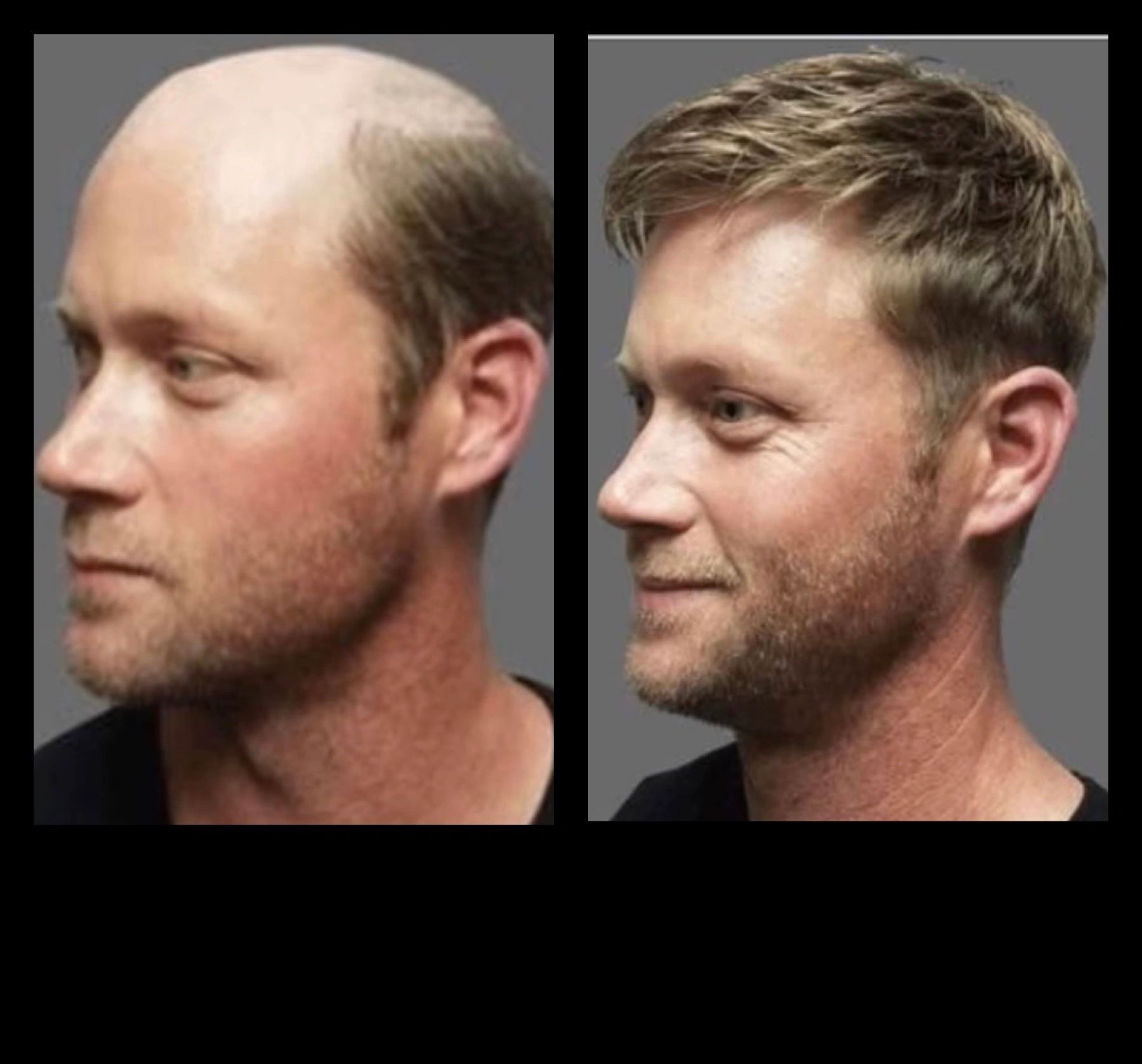 Men’s Hair Replacement System Fitting Darlington UK 