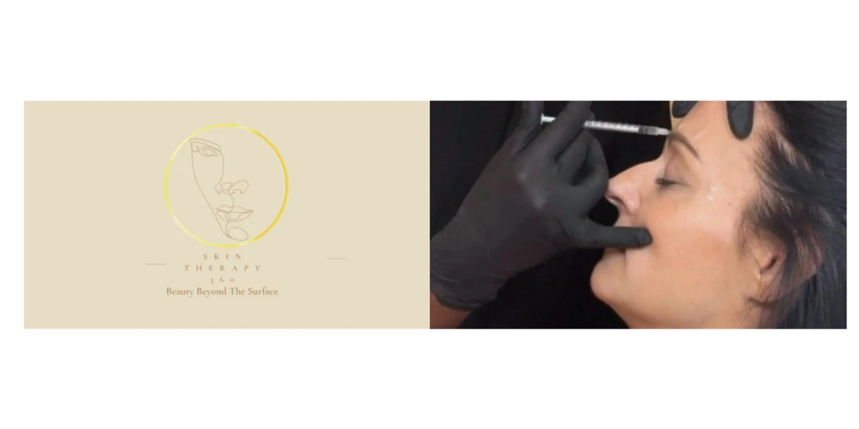 Anti-Wrinkle treatment - Botox