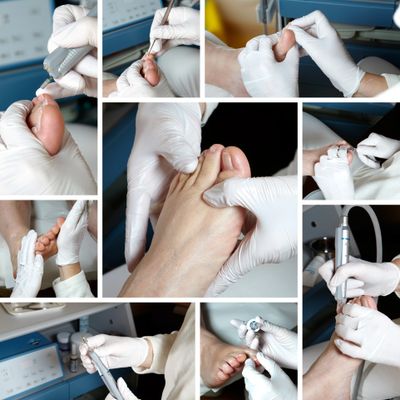 Collage of professional foot care and podiatry treatment on a patient's foot.