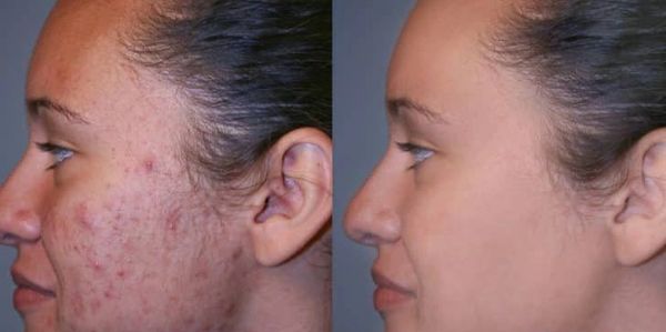 Perfect result of acne scar after CO2 Laser Treatment