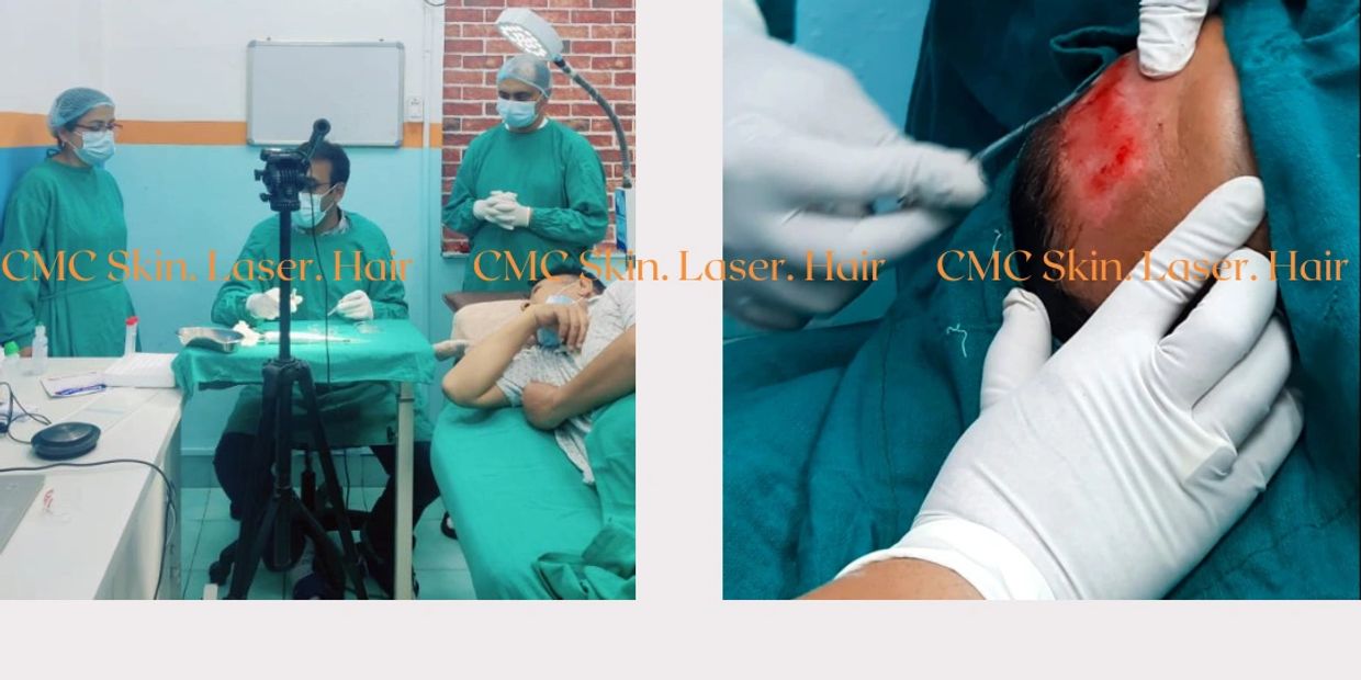 Melanocyte Transplant Surgery for Vitiligo Treatment