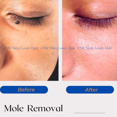 Mole Removal