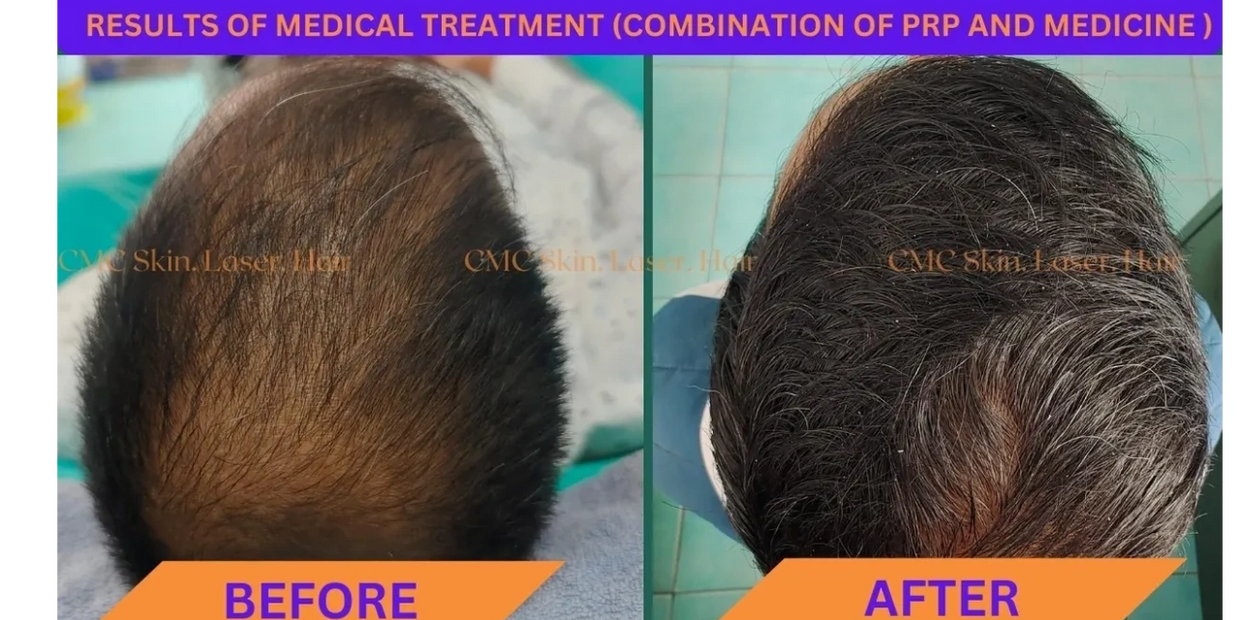 Result of PRP Therapy combination of Medicine for hair fall Treatment