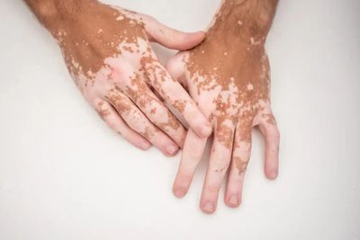 Vitiligo Treatment