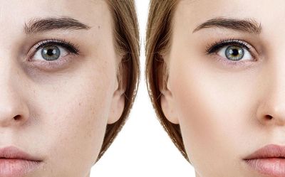 Dark circle treatment 