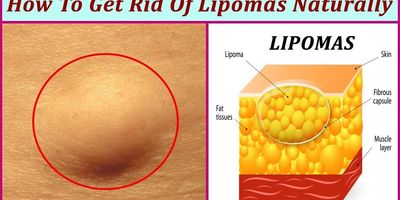 Lipomas Removal Center