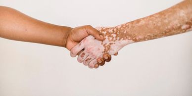 Vitiligo Treatment Center in Nepal