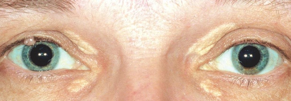 Xanthelasma 