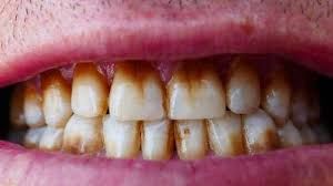 Does Smoking Cause Teeth to Turn Yellow?