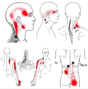 Pinpointing the Pain with Trigger Point Therapy - Mpls.St.Paul Magazine