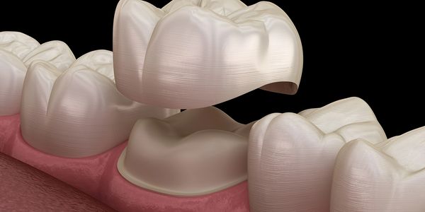 Dental Crowns - spokane dentist providing cosmetic crowns veneers bridges