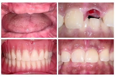 Four images showing before and after replacement of missing teeth with dentures and dental implants