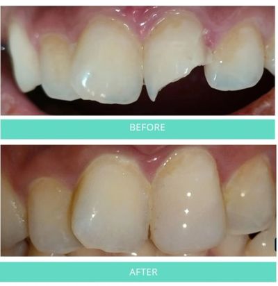 TOOTH COLORED FILLING OF A BROKEN TOOTH