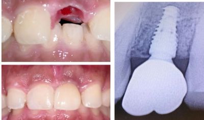 Dental implants in Kothrud