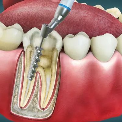 ROOT CANAL TREATMENT
