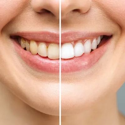 TEETH WHITENING
