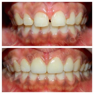 Before and after dental treatment showing improved teeth alignment and gap closure.