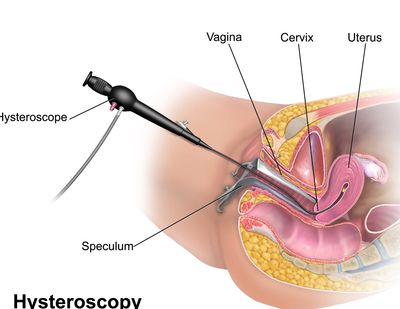 A showcase of a Hysteroscopy with anatomy