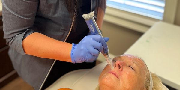 microneedling 