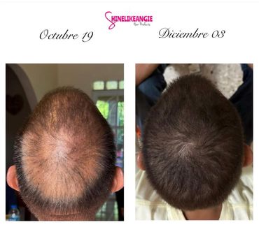 Before and after hair growth transformation from October to December.