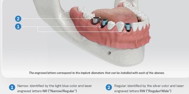 The Neodent® EasyGuide Sleeve is selected according to mesiodistal space and implant diameter.
Durin