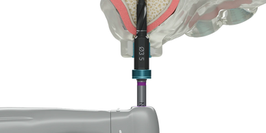 Neodent® EasyGuide GM implant drivers allow fully guided insertion of Helix GM™ implants using Narro