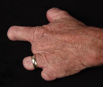 Left hand after accident in Cisco, Texas 1944