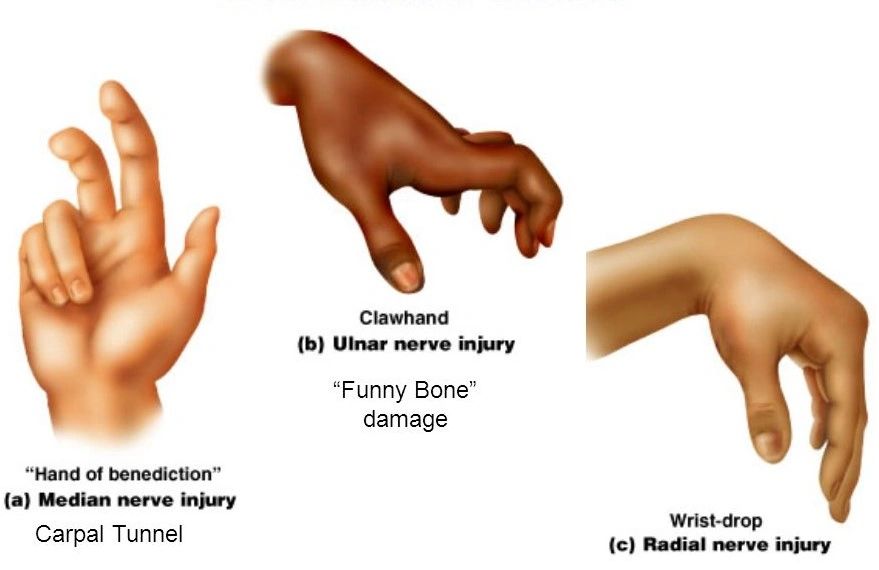 ulnar nerve injury