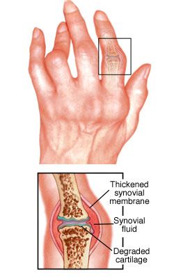 rheumatoid arthritis thumb