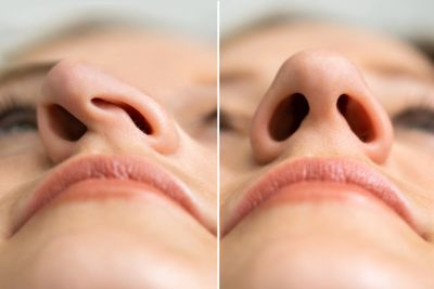 Results of a rhinoplasty for deviated septum